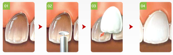 veneer-img-04.jpg